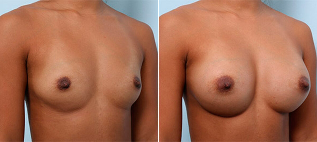 Breast Augmentation before and after photos in Houston, TX, Patient 26218