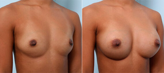 Breast Augmentation before and after photos in Houston, TX, Patient 26218