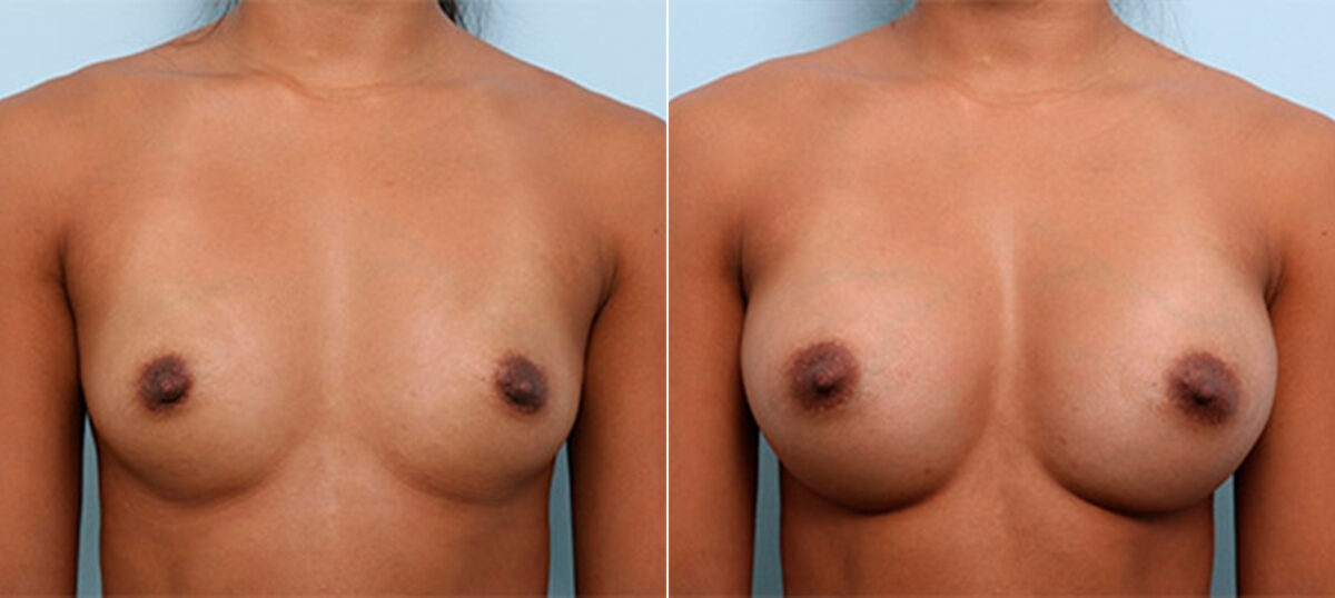 Breast Augmentation before and after photos in Houston, TX, Patient 26218