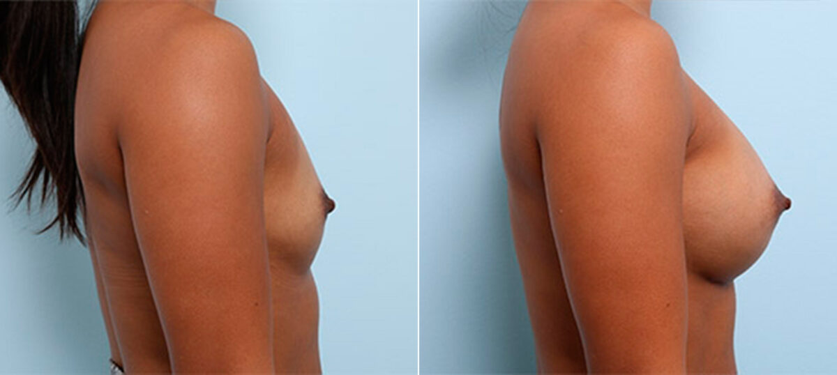 Breast Augmentation before and after photos in Houston, TX, Patient 26218
