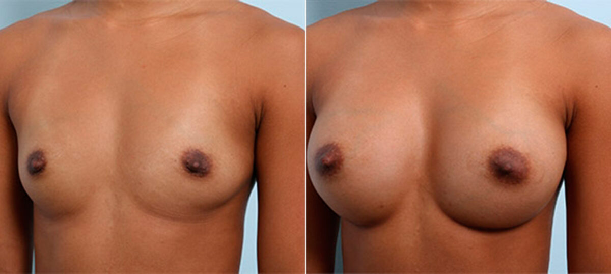 Breast Augmentation before and after photos in Houston, TX, Patient 26218