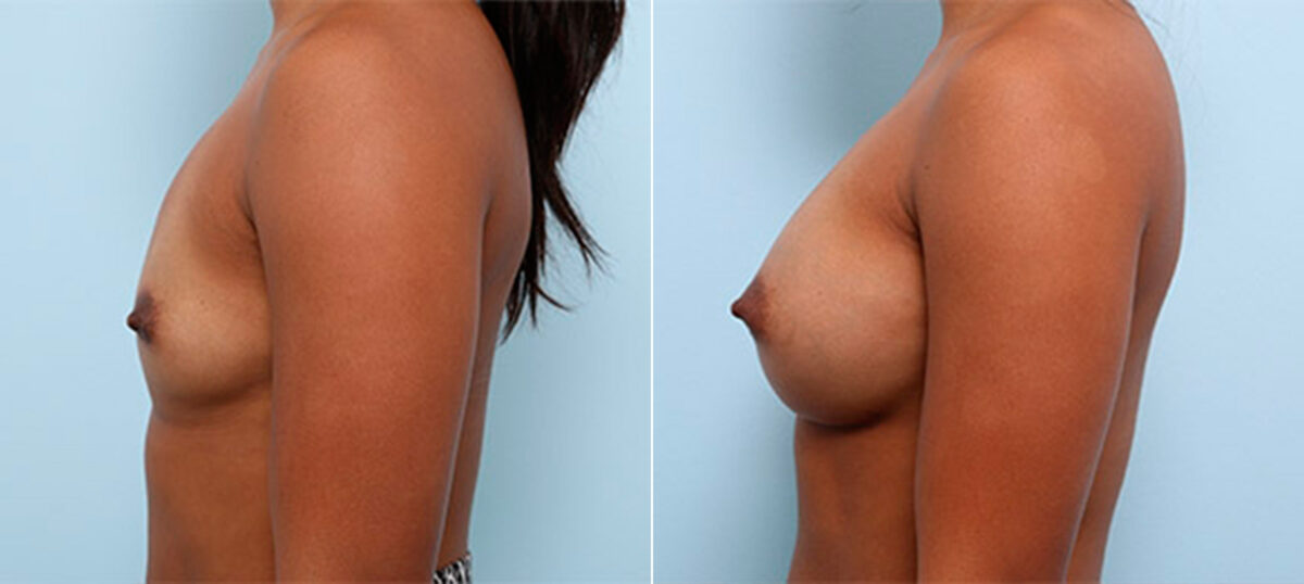 Breast Augmentation before and after photos in Houston, TX, Patient 26218