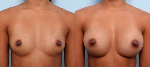 Breast Augmentation before and after photos in Houston, TX, Patient 26218