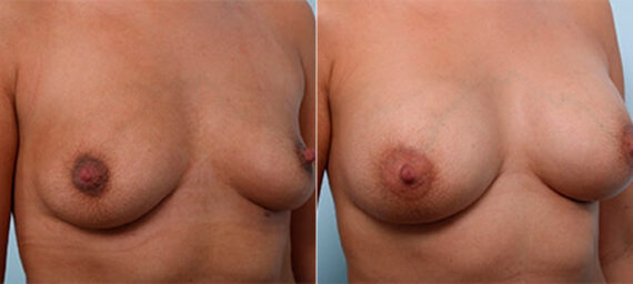 Breast Augmentation before and after photos in Houston, TX, Patient 26229