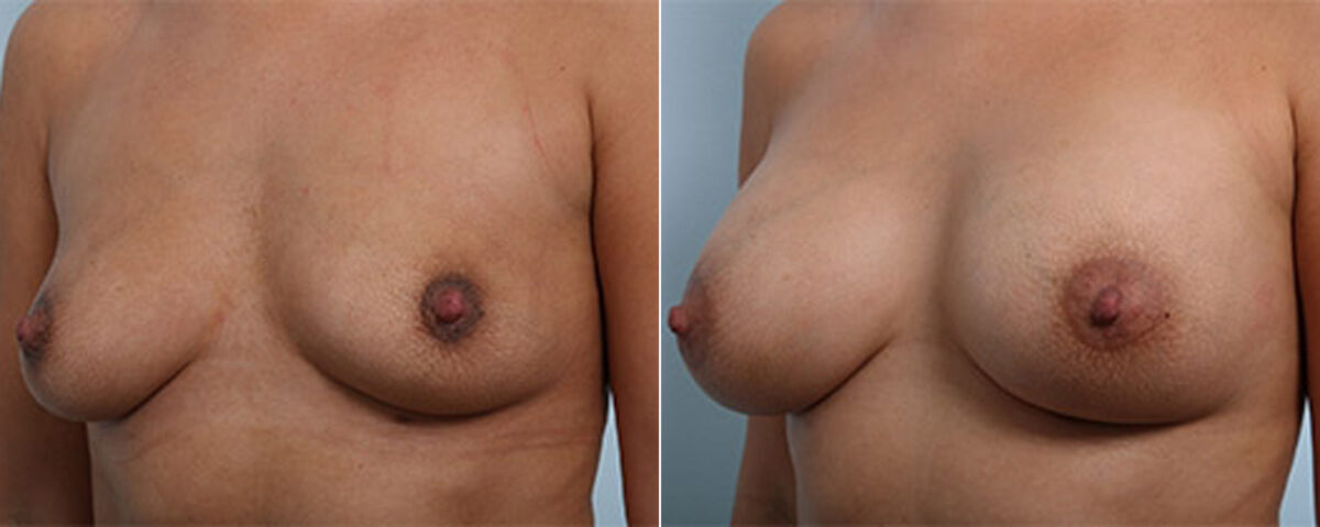 Breast Augmentation before and after photos in Houston, TX, Patient 26229