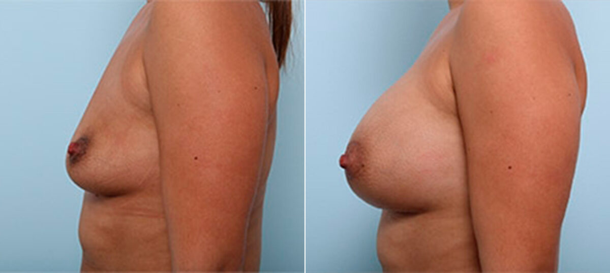 Breast Augmentation before and after photos in Houston, TX, Patient 26229