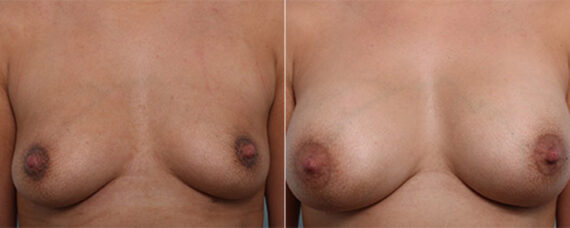 Breast Augmentation before and after photos in Houston, TX, Patient 26229