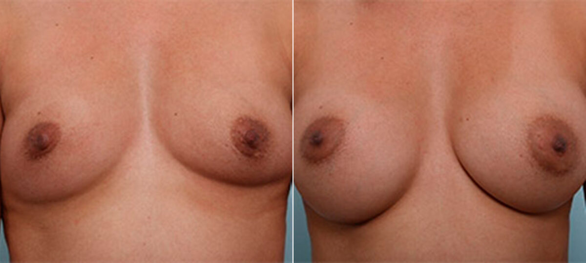 Breast Augmentation before and after photos in Houston, TX, Patient 26240