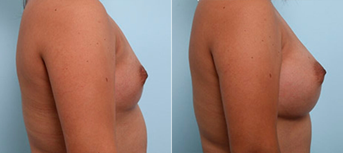 Breast Augmentation before and after photos in Houston, TX, Patient 26240