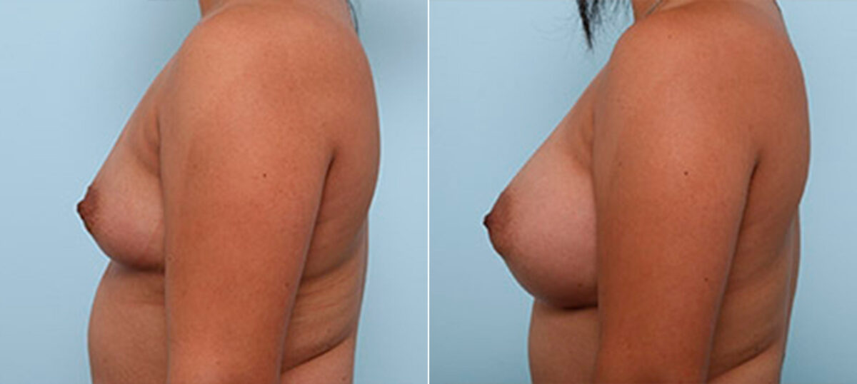 Breast Augmentation before and after photos in Houston, TX, Patient 26240
