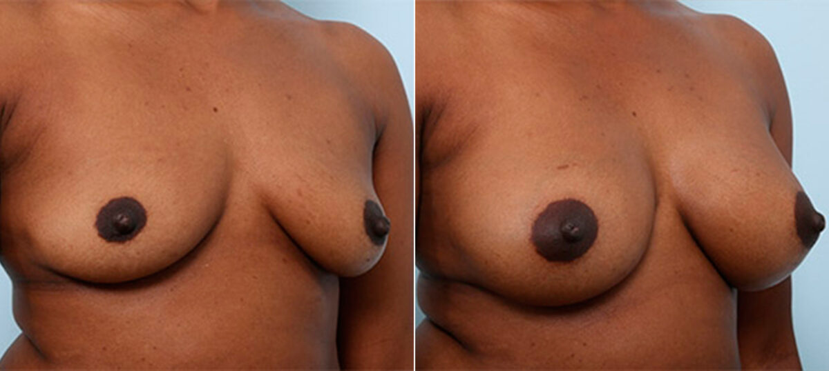 Breast Augmentation before and after photos in Houston, TX, Patient 26251