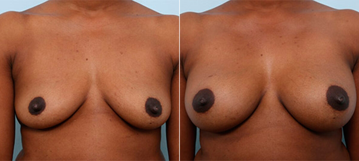 Breast Augmentation before and after photos in Houston, TX, Patient 26251