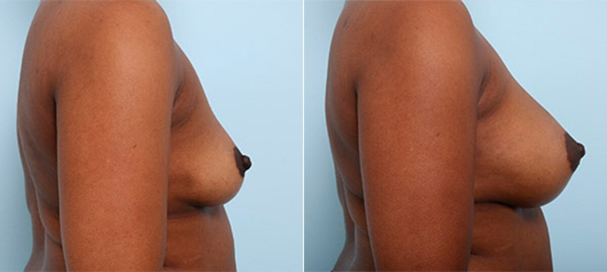 Breast Augmentation before and after photos in Houston, TX, Patient 26251