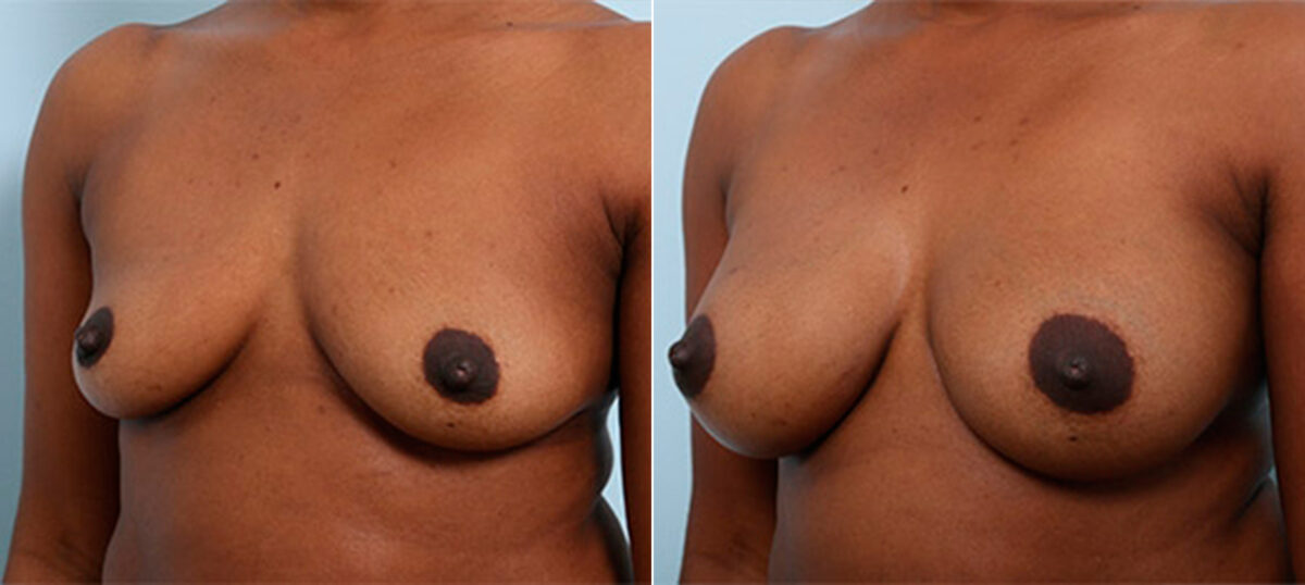 Breast Augmentation before and after photos in Houston, TX, Patient 26251