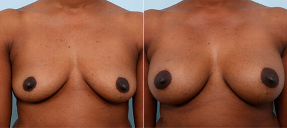 Breast Augmentation before and after photos in Houston, TX, Patient 26251