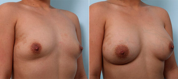 Breast Augmentation before and after photos in Houston, TX, Patient 26262