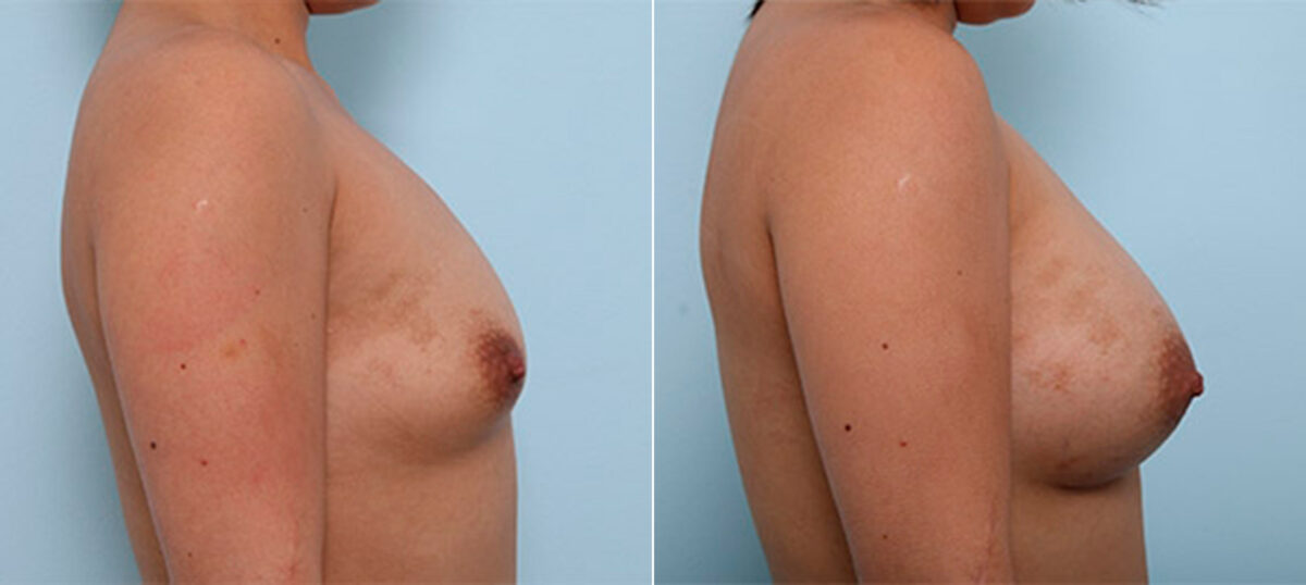 Breast Augmentation before and after photos in Houston, TX, Patient 26262
