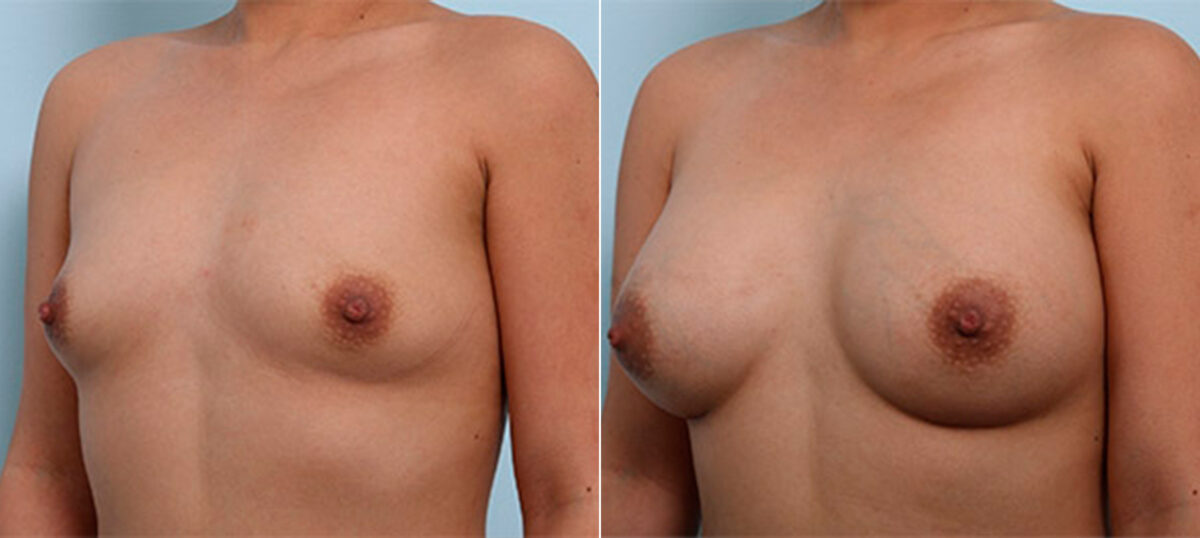 Breast Augmentation before and after photos in Houston, TX, Patient 26262