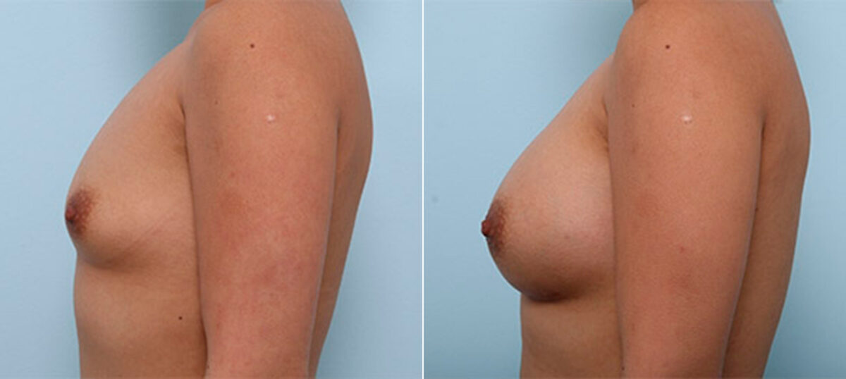 Breast Augmentation before and after photos in Houston, TX, Patient 26262