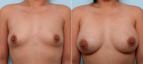 Breast Augmentation before and after photos in Houston, TX, Patient 26262