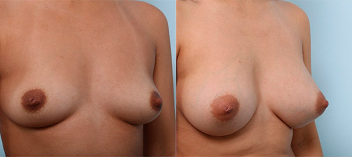 Breast Augmentation before and after photos in Houston, TX, Patient 26273