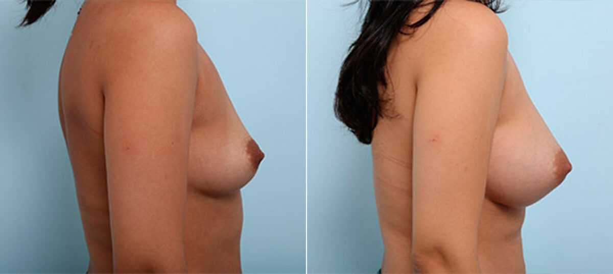 Breast Augmentation before and after photos in Houston, TX, Patient 26273