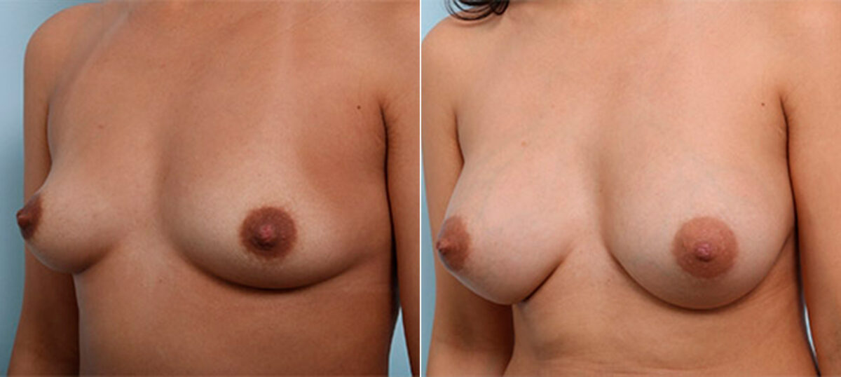 Breast Augmentation before and after photos in Houston, TX, Patient 26273