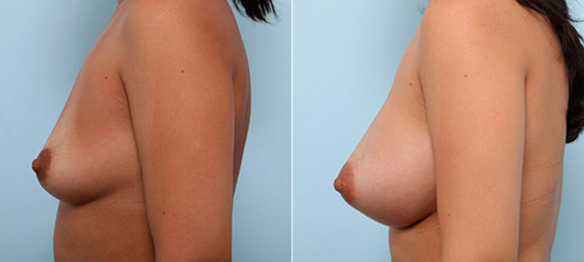 Breast Augmentation before and after photos in Houston, TX, Patient 26273