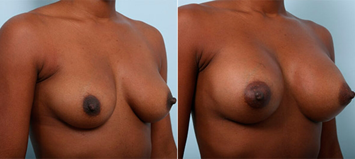 Breast Augmentation before and after photos in Houston, TX, Patient 26284