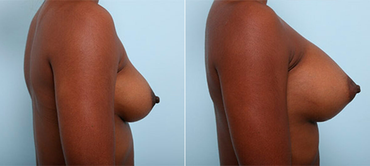 Breast Augmentation before and after photos in Houston, TX, Patient 26284