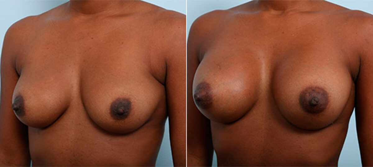 Breast Augmentation before and after photos in Houston, TX, Patient 26284