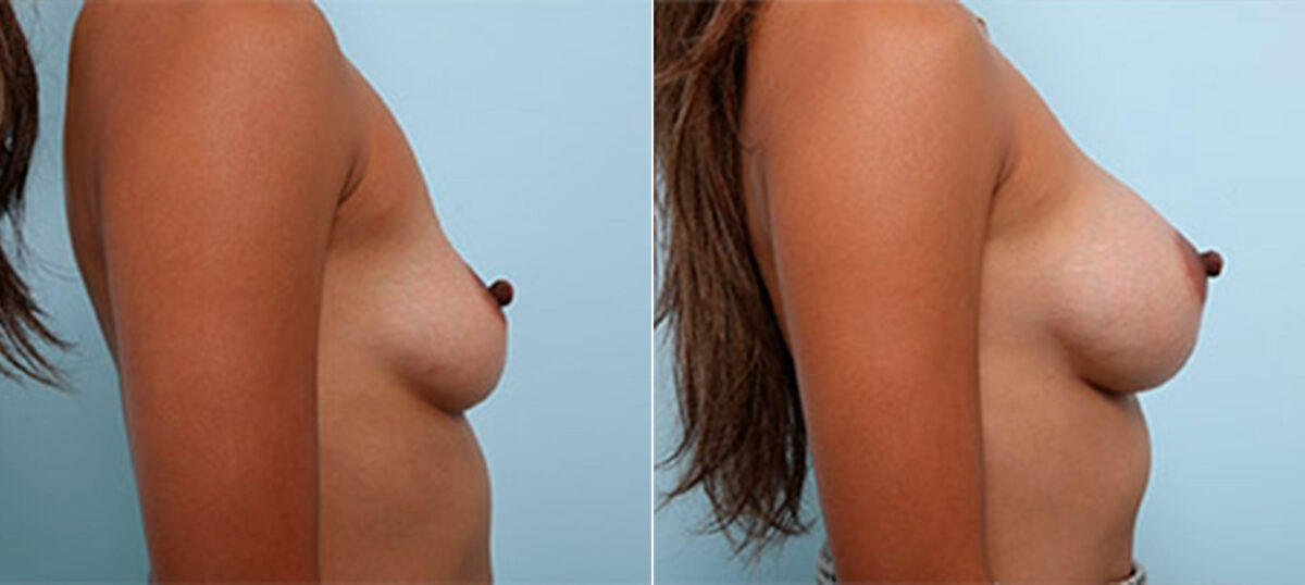 Breast Augmentation before and after photos in Houston, TX, Patient 26295