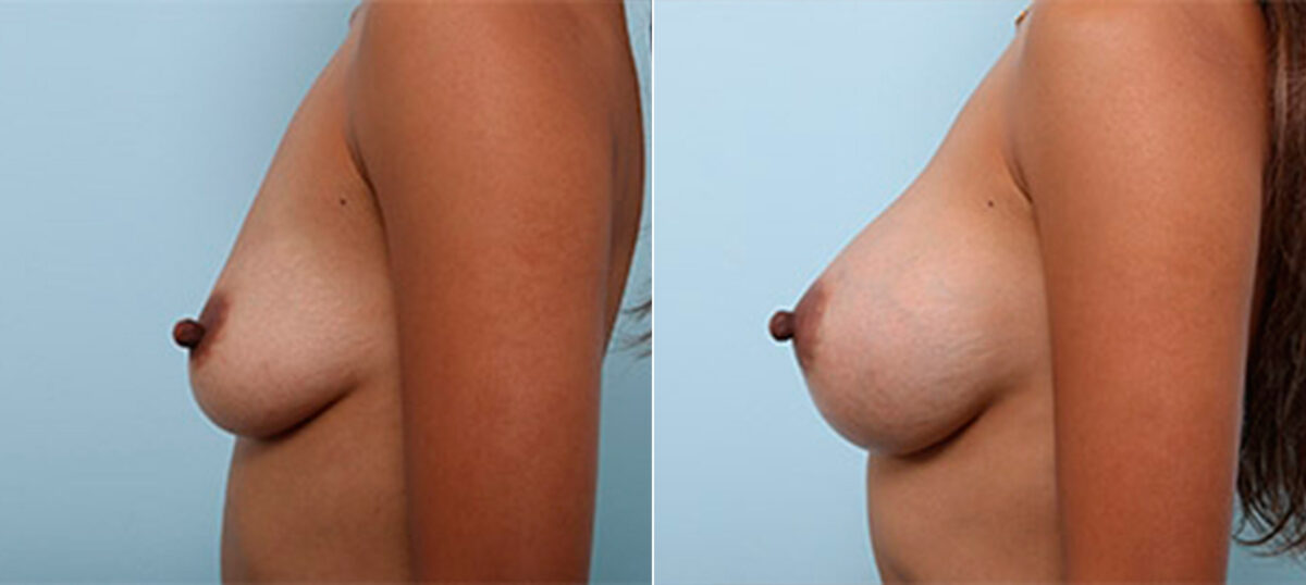 Breast Augmentation before and after photos in Houston, TX, Patient 26295