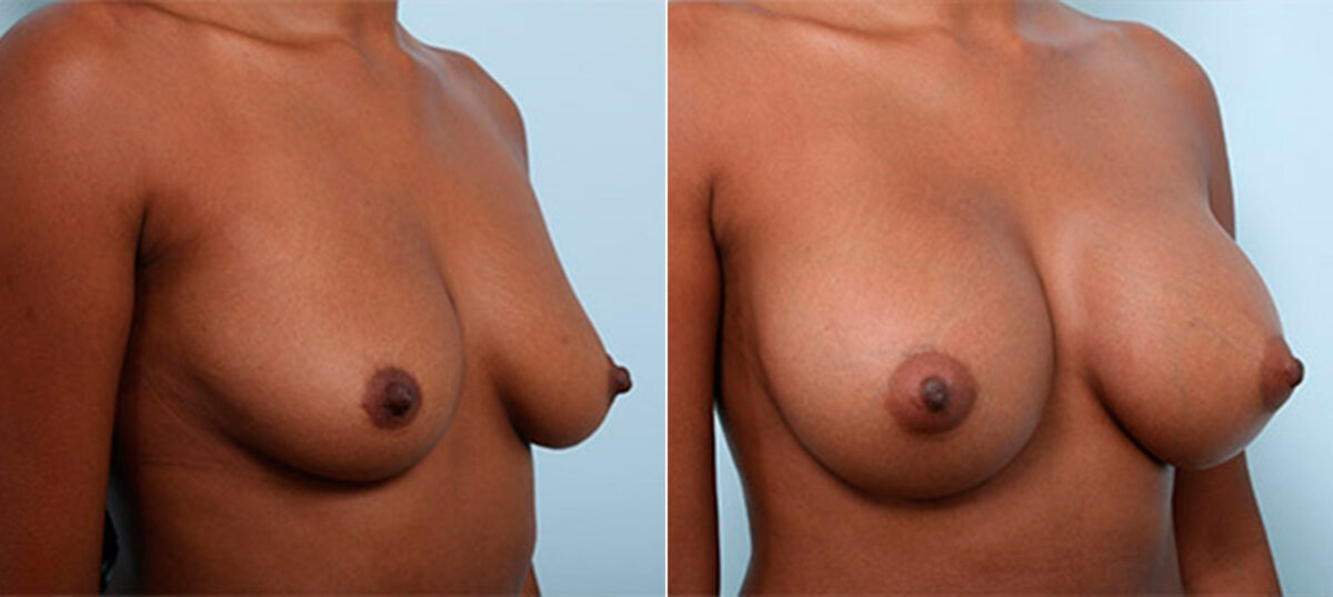 Breast Augmentation before and after photos in Houston, TX, Patient 26306