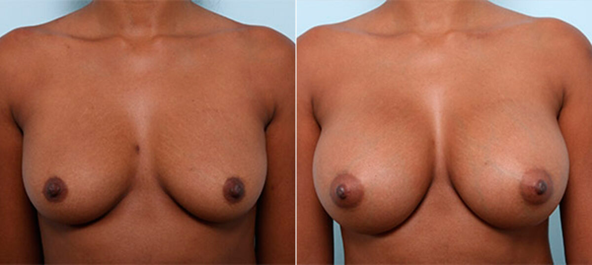 Breast Augmentation before and after photos in Houston, TX, Patient 26306