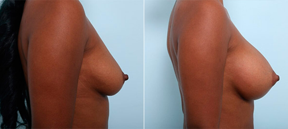 Breast Augmentation before and after photos in Houston, TX, Patient 26306