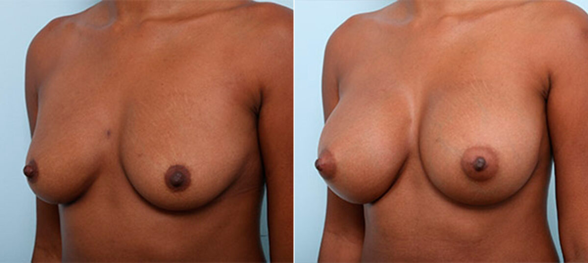Breast Augmentation before and after photos in Houston, TX, Patient 26306