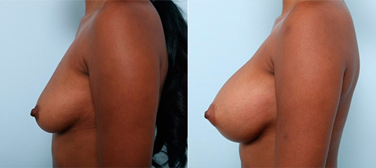 Breast Augmentation before and after photos in Houston, TX, Patient 26306