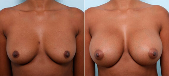 Breast Augmentation before and after photos in Houston, TX, Patient 26306