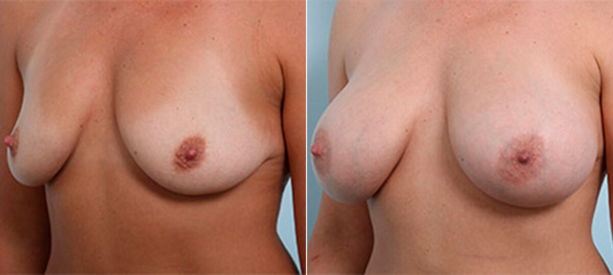 Breast Augmentation before and after photos in Houston, TX, Patient 26317