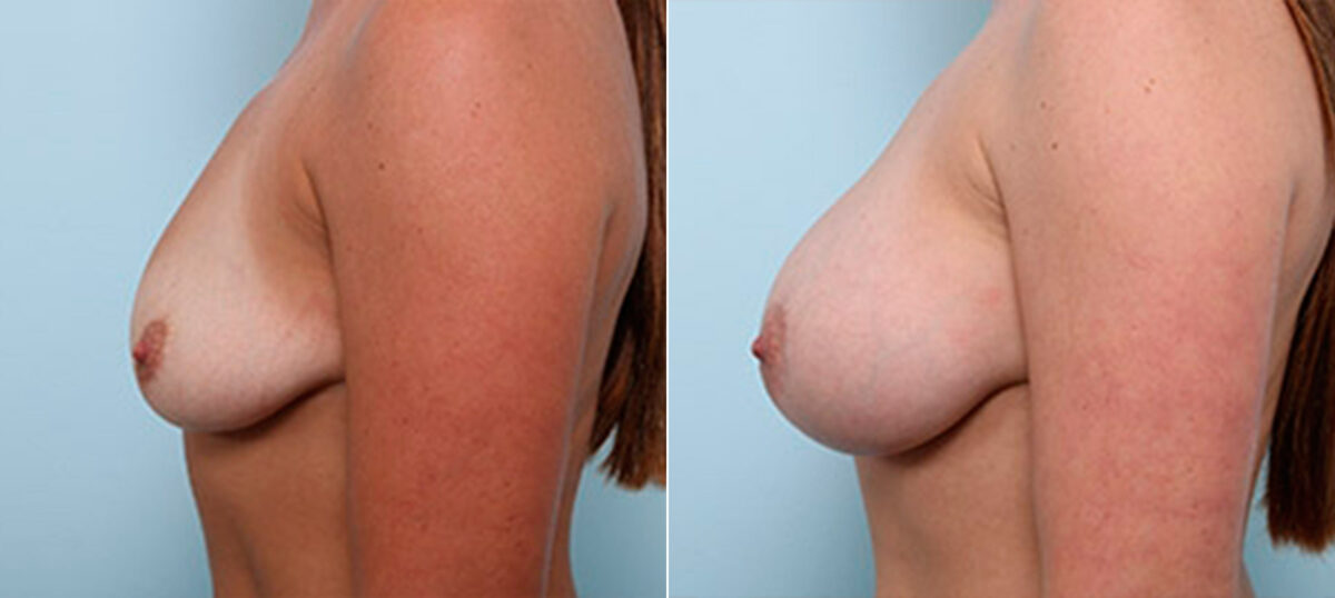 Breast Augmentation before and after photos in Houston, TX, Patient 26317