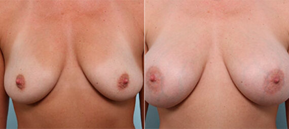 Breast Augmentation before and after photos in Houston, TX, Patient 26317