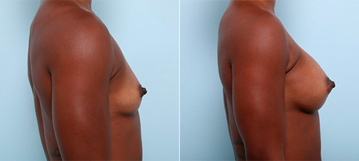 Breast Augmentation before and after photos in Houston, TX, Patient 26328