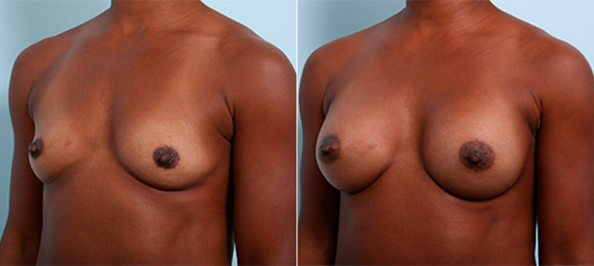 Breast Augmentation before and after photos in Houston, TX, Patient 26328