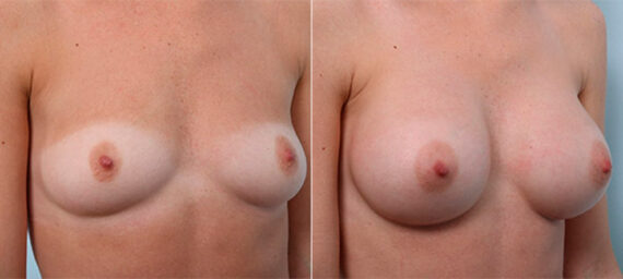 Breast Augmentation before and after photos in Houston, TX, Patient 26339
