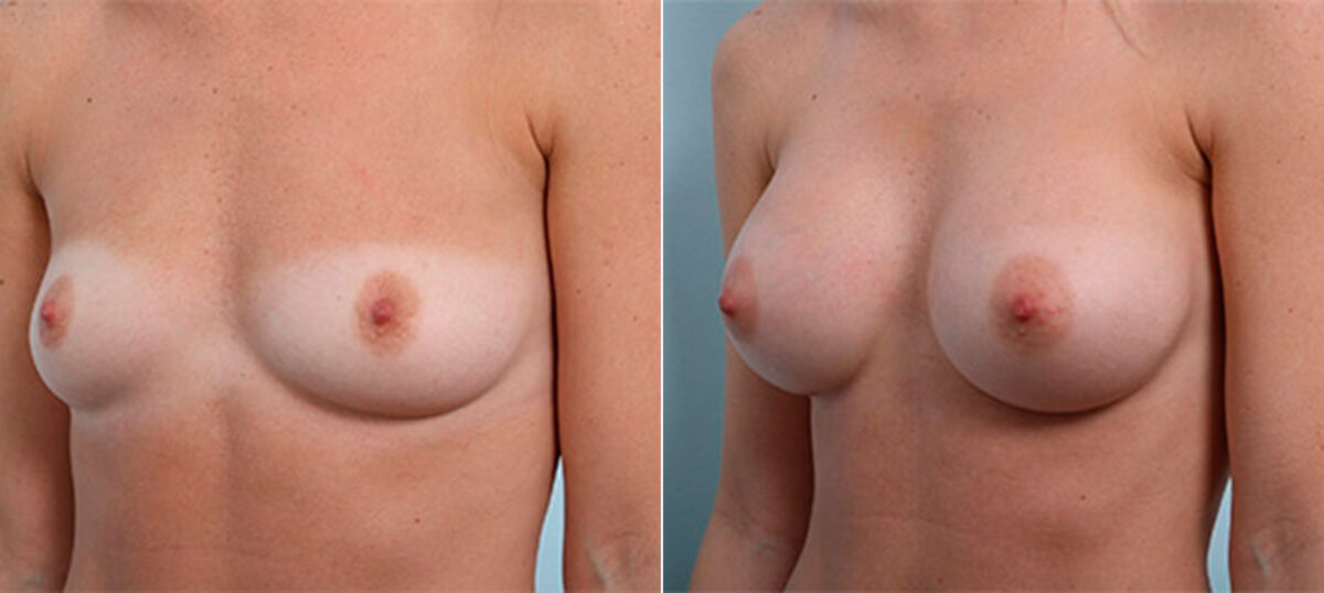 Breast Augmentation before and after photos in Houston, TX, Patient 26339