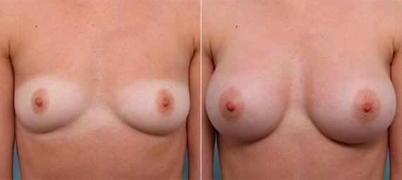 Breast Augmentation before and after photos in Houston, TX, Patient 26339