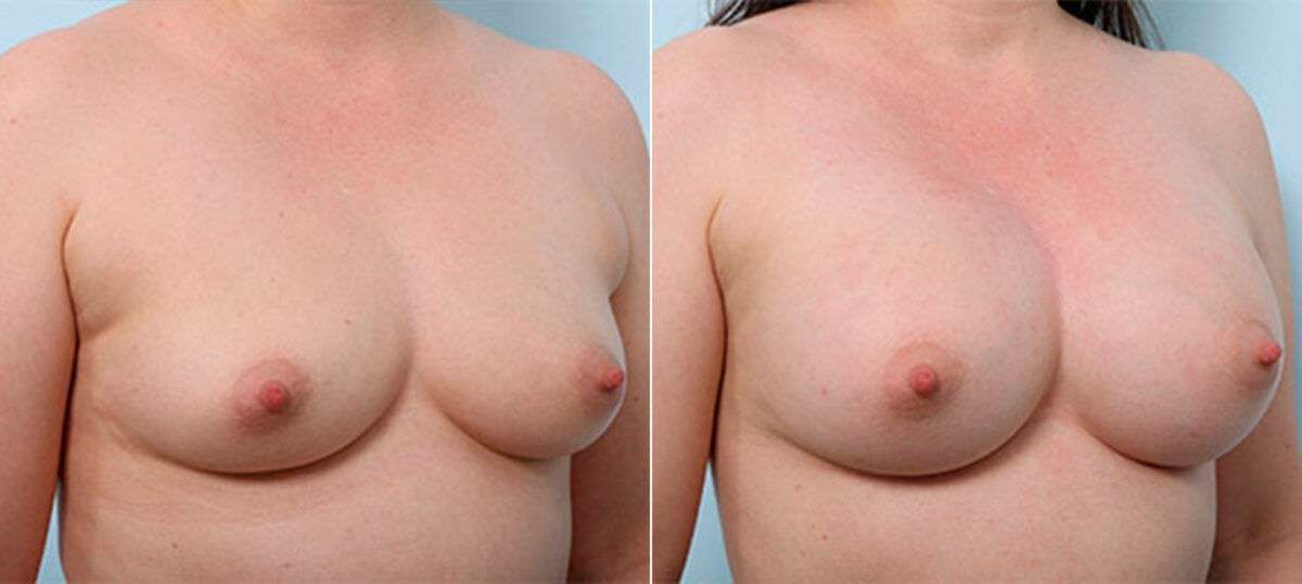 Breast Augmentation before and after photos in Houston, TX, Patient 26350