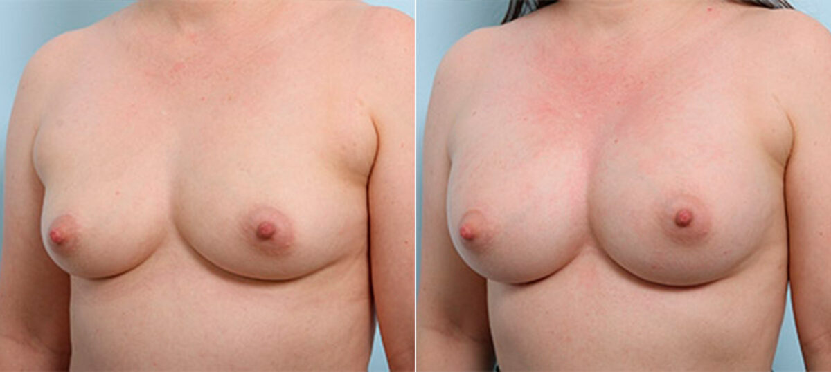 Breast Augmentation before and after photos in Houston, TX, Patient 26350