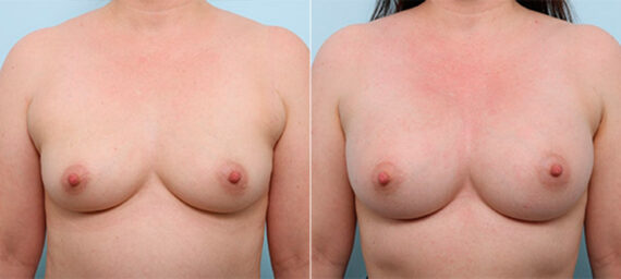 Breast Augmentation before and after photos in Houston, TX, Patient 26350